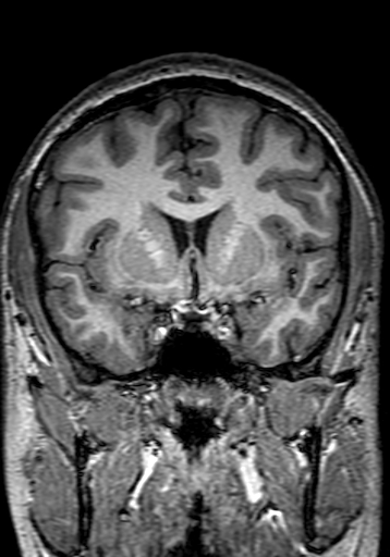 Cerebral arteriovenous malformation at posterior body of corpus callosum (Radiopaedia 74111-84925 Coronal T1 120).jpg