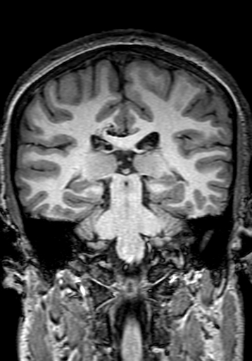 File:Cerebral arteriovenous malformation at posterior body of corpus callosum (Radiopaedia 74111-84925 Coronal T1 205).jpg