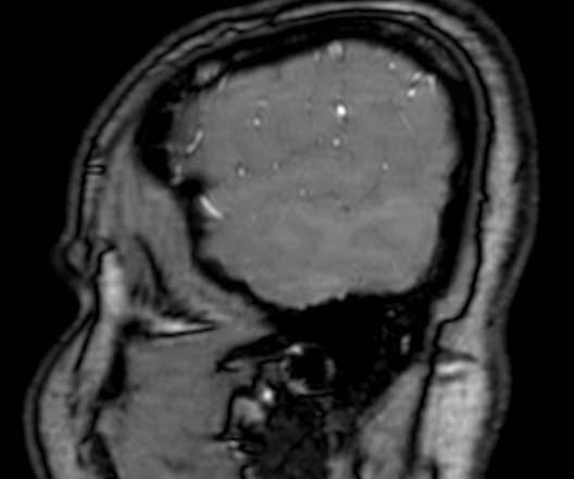 File:Cerebral arteriovenous malformation at posterior body of corpus callosum (Radiopaedia 74111-84925 J 14).jpg
