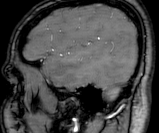 Cerebral arteriovenous malformation at posterior body of corpus callosum (Radiopaedia 74111-84925 J 46).jpg