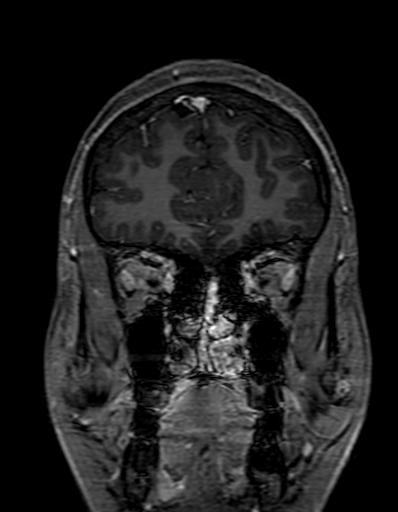 Cerebral arteriovenous malformation at posterior body of corpus callosum (Radiopaedia 74111-84925 K 62).jpg