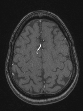 Cerebral arteriovenous malformation with hemorrhage (Radiopaedia 34422-35737 Axial MRA 68).png