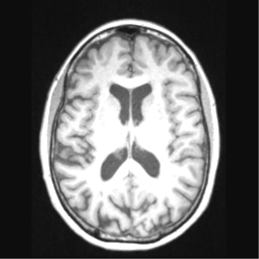 Cerebral arteriovenous malformation with hemorrhage (Radiopaedia 34422-35737 Axial T1 44).png
