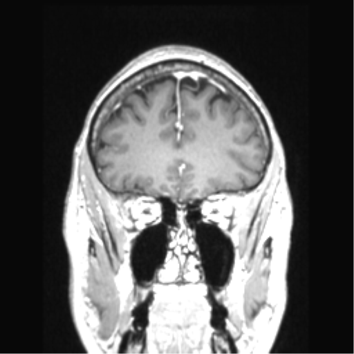 Cerebral arteriovenous malformation with hemorrhage (Radiopaedia 34422-35737 Coronal T1 C+ 70).png