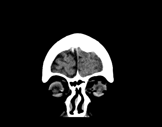 File:Cerebral arteriovenous malformation with lobar hemorrhage (Radiopaedia 44725-48510 Coronal non-contrast 9).png