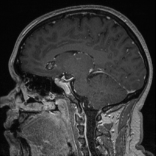 Cerebral cavernoma and development venous anomaly (Radiopaedia 37603-39482 Sagittal T1 C+ 43).png