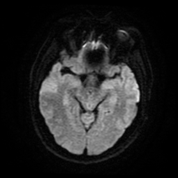 File:Cerebral cavernous venous malformation (Zabramski type II) (Radiopaedia 85511-101198 Axial DWI 14).jpg