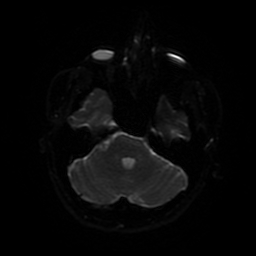 File:Cerebral cavernous venous malformation (Zabramski type II) (Radiopaedia 85511-101198 Axial DWI 76).jpg