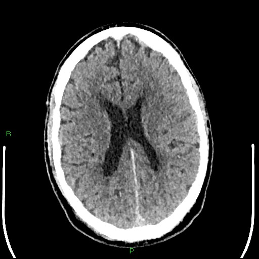 Cerebral contusions (Radiopaedia 33868-35039 Axial non-contrast 132).jpg