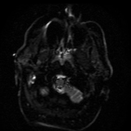 Cerebral embolic infarcts (embolic shower) (Radiopaedia 49837-55108 Axial DWI 46).jpg