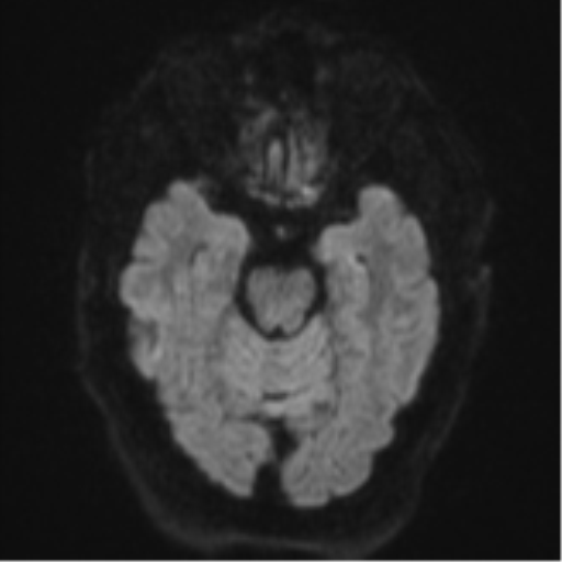 Cerebral embolic infarcts (embolic shower) (Radiopaedia 57395-64342 Axial DWI 49).png