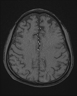 Cerebral embolic infarcts (embolic shower) (Radiopaedia 72391-82921 Axial MRA 146).jpg