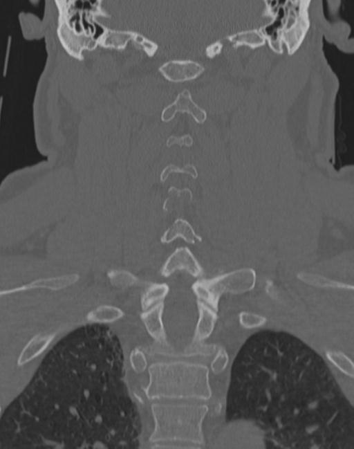 Cerebral hemorrhagic contusions and cervical spine fractures (Radiopaedia 32865-33841 Coronal bone window 47).jpg