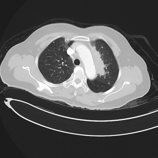 Cerebral metastases (Radiopaedia 33041-34055 Axial lung window 17).png