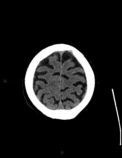 File:Cerebral metastases - ependymal and parenchymal (Radiopaedia 79877-93131 Axial non-contrast 69).jpg