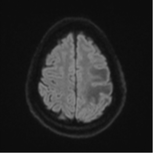 File:Cerebral metastases mimicking multifocal glioblastoma (Radiopaedia 50843-56353 Axial DWI 49).png
