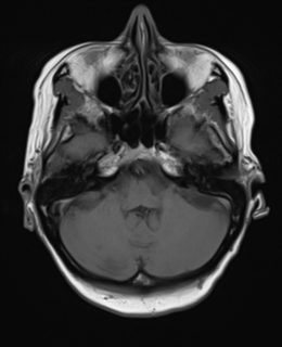 File:Cerebral metastasis (Radiopaedia 46744-51248 Axial T1 6).png