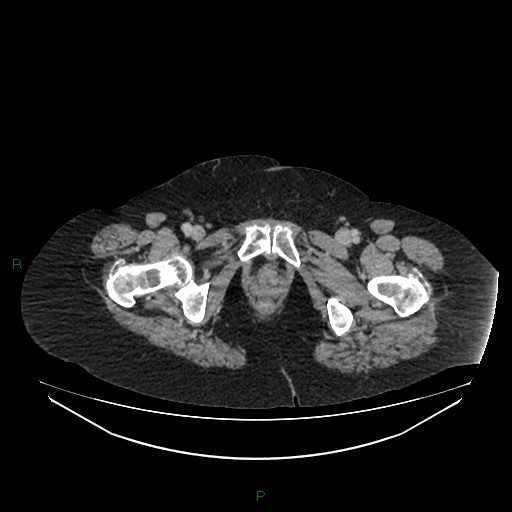 Cerebral metastasis from renal cell carcinoma (Radiopaedia 82306-96378 A 196).jpg