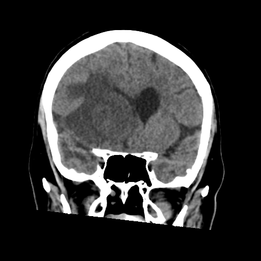 Cerebral metastasis to basal ganglia (Radiopaedia 81568-95412 Coronal non-contrast 27).png