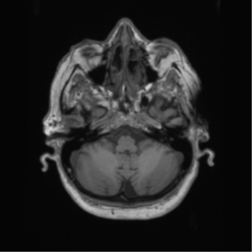 Cerebral metastasis to basal ganglia (Radiopaedia 81568-95413 Axial T1 13).png