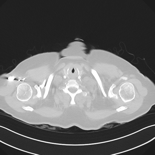 File:Cerebral metastasis to basal ganglia (Radiopaedia 81568-95414 Axial lung window 1).png