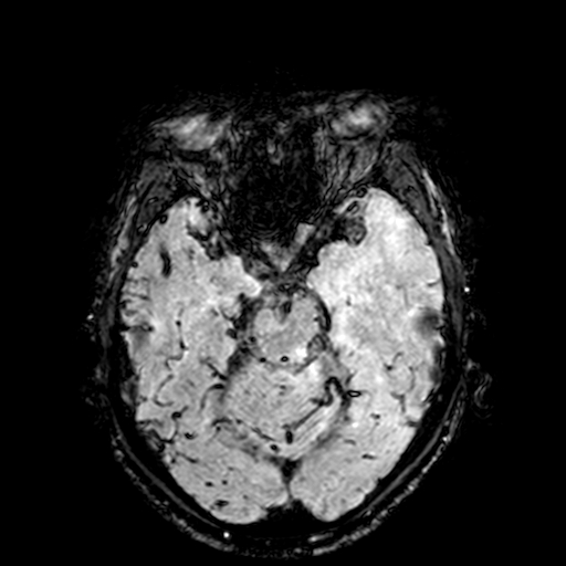 Cerebral parenchymal arteriovenous malformation (Radiopaedia 27280-27456 Axial SWI 35).jpg