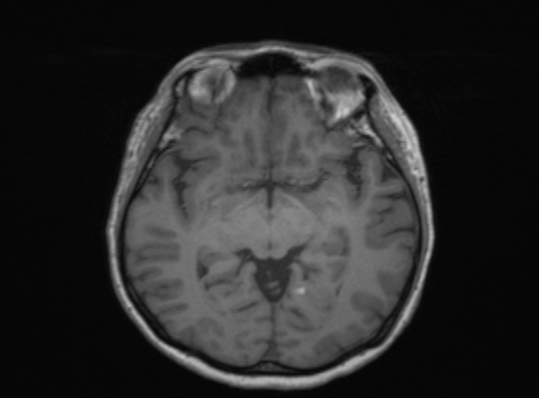 Cerebral ring enhancing lesions - cerebral metastases (Radiopaedia 44922-48817 Axial T1 245).jpg