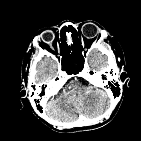 Cerebral ring enhancing lesions - cerebral metastases (Radiopaedia 44922-48818 B 72).jpg