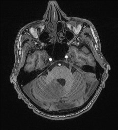 File:Cerebral toxoplasmosis (Radiopaedia 43956-47461 Axial T1 20).jpg