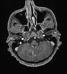 Cerebral toxoplasmosis (Radiopaedia 43956-47461 Axial T1 C+ 11).jpg