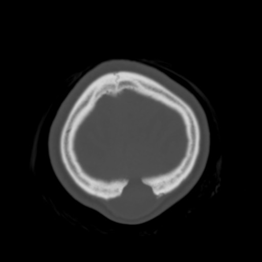 Cerebral tuberculosis with dural sinus invasion (Radiopaedia 60353-68018 Axial bone window 59).jpg