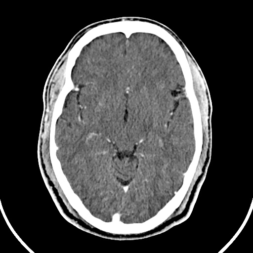 File:Cerebral venous angioma (Radiopaedia 69959-79977 B 36).jpg