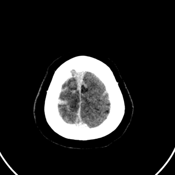 Cerebral venous hemorrhagic infarct from venous sinus thrombosis (Radiopaedia 55433-61883 Axial C+ delayed 16).jpg