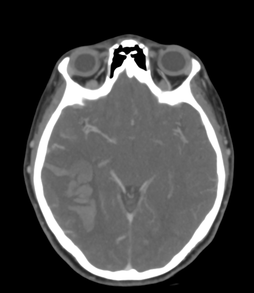Cerebral venous hemorrhagic infarction (Radiopaedia 38461-40550 Axial MIP VENOGRAM 24).png