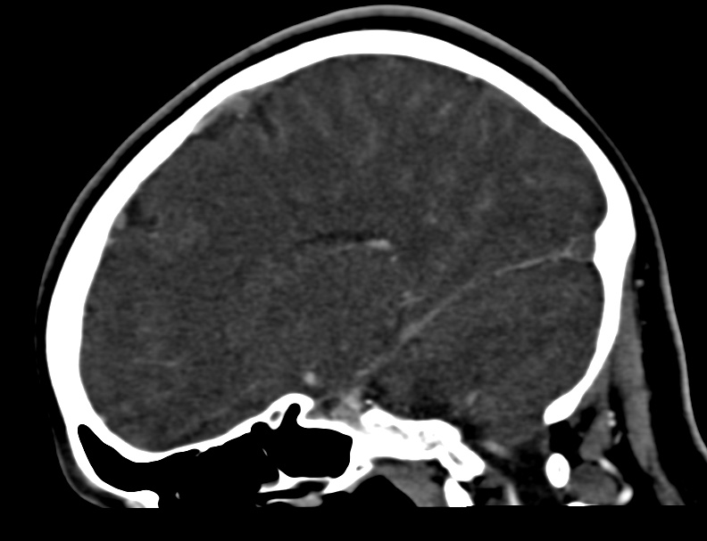 Cerebral venous sinus thrombosis (Radiopaedia 59224-66646 Sagittal C+ delayed 34).jpg