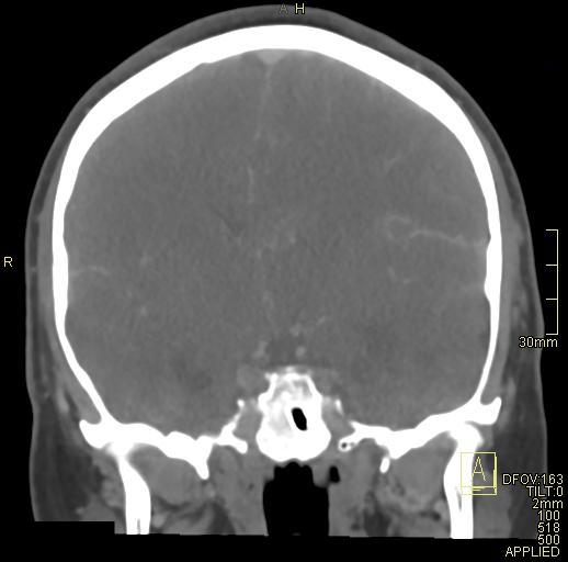 Cerebral venous sinus thrombosis (Radiopaedia 91329-108965 Coronal venogram 43).jpg