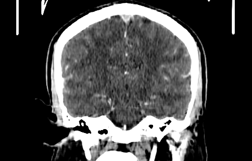Cerebral venous thrombosis (CVT) (Radiopaedia 77524-89685 C 35).jpg