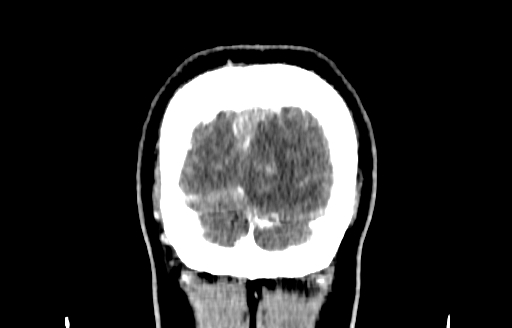 Cerebral venous thrombosis (CVT) (Radiopaedia 77524-89685 C 62).jpg