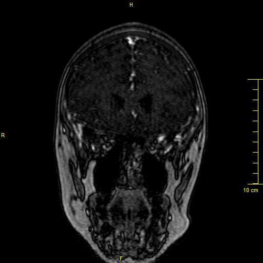 Cerebral venous thrombosis (Radiopaedia 23288-23351 MRV 26).JPG