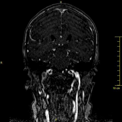 Cerebral venous thrombosis (Radiopaedia 23288-23351 MRV 93).JPG