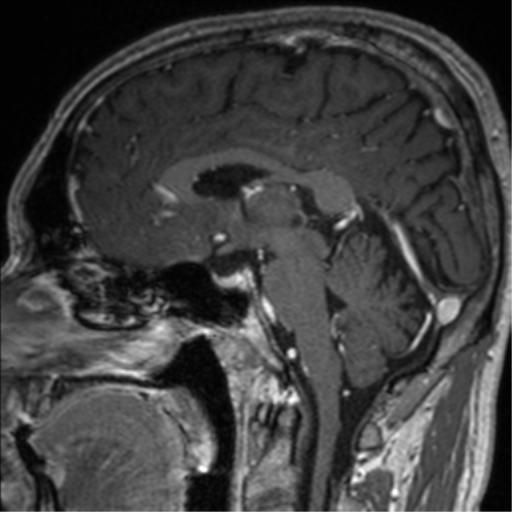 Cerebral venous thrombosis (Radiopaedia 38392-40469 Sagittal T1 C+ 44).png