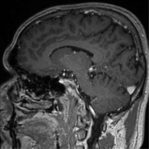 Cerebral venous thrombosis (Radiopaedia 38392-40469 Sagittal T1 C+ 51).png