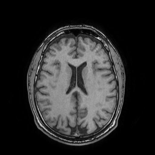 File:Cerebral venous thrombosis with secondary intracranial hypertension (Radiopaedia 89842-106957 Axial T1 110).jpg