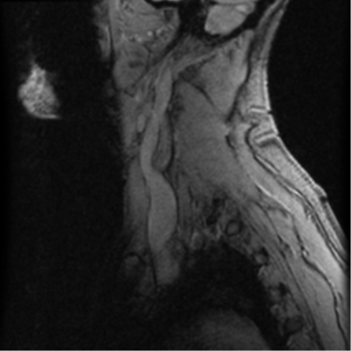 File:Cervical canal stenosis with cord compression (Radiopaedia 34114-35374 D 2).png