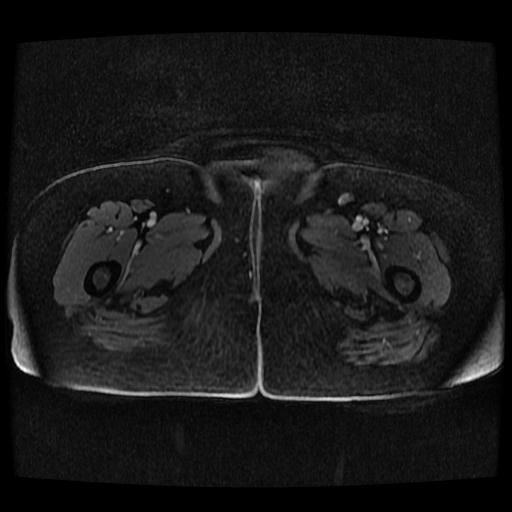 Cervical carcinoma (Radiopaedia 70924-81132 Axial T1 C+ fat sat 97).jpg