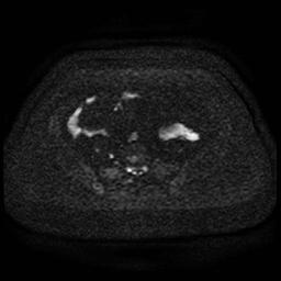 Cervical carcinoma (Radiopaedia 85405-101028 Axial DWI 59).jpg