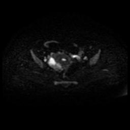 Cervical carcinoma (Radiopaedia 88010-104555 Axial DWI 33).jpg