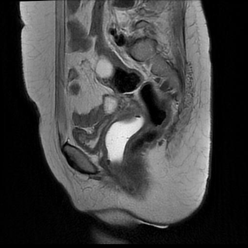 File:Cervical carcinoma (Radiopaedia 88010-104555 Sagittal T2 13).jpg