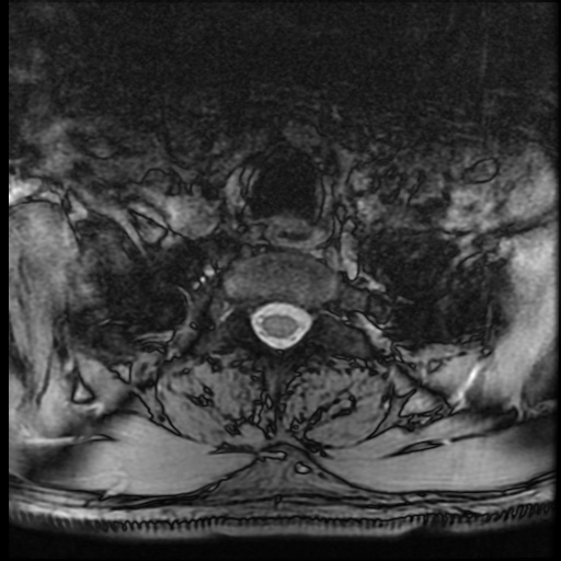 Cervical disc extrusion (Radiopaedia 59074-66364 G 104).jpg
