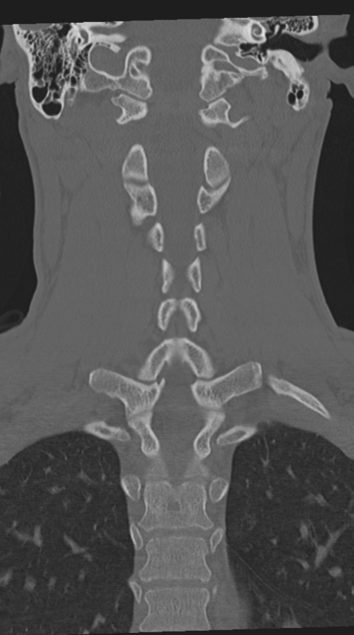 Cervical intercalary bone (Radiopaedia 35211-36748 Coronal bone window 46).png